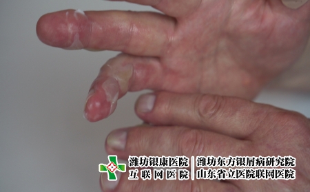 摄图网_327232650_一个人手头上涂满了二等热水的药膏 皮肤肿胀 全身发泡男人男性疾病伤害烧伤烫伤疼痛药品医院警告（企业商用）