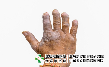 摄图网_324104120_隔离在白种背景 皮肤病和皮肤衰竭的农民手中的丝虫病近距离特写 而Psoralpic手指畸形（企业商用）
