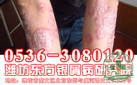 银屑病症状