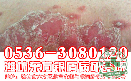 脓疱型银屑病