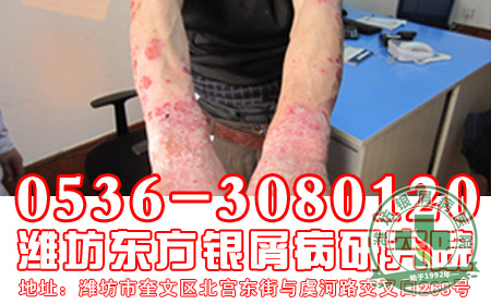 银屑病病因