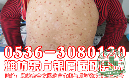 牛皮癣症状