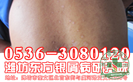 牛皮癣治疗