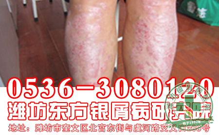 银屑病治疗