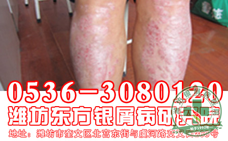 牛皮癣常识