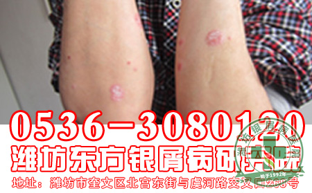 牛皮癣常识
