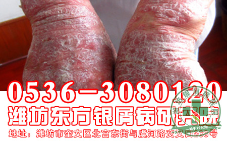 银屑病复发