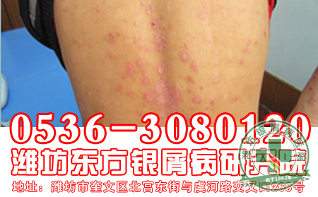 银屑病护理
