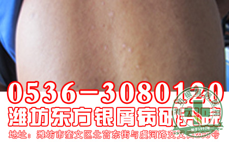 牛皮癣症状