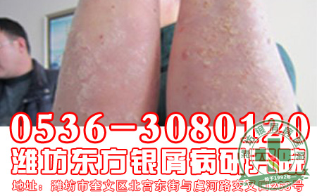 济南牛皮癣医院主任告诉您治疗牛皮癣 关键的