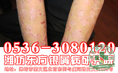 牛皮癣患者如何选择药物治疗呢?