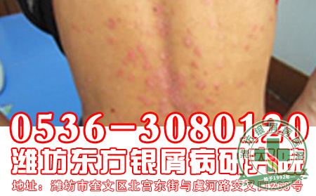 科学的洗澡可以预防牛皮癣吗?