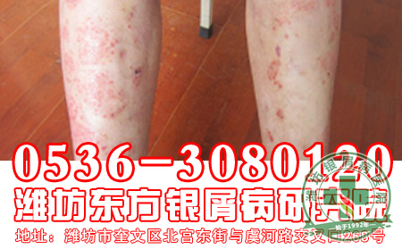 2013世界银屑病日，关爱银屑病患者健康