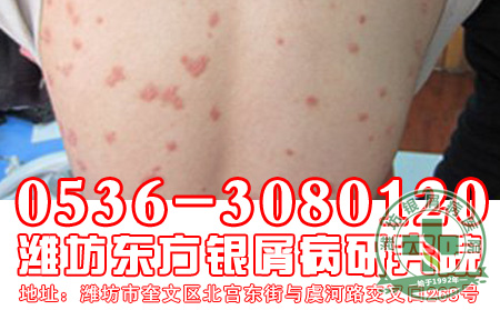 为什么越来越多的女性遭受牛皮癣的困扰?