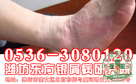 牛皮癣患者关注：牛皮癣要早治疗
