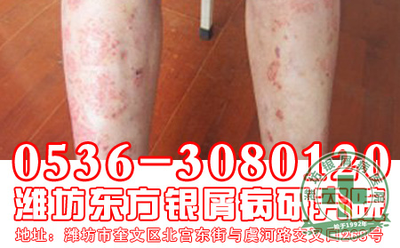 女性牛皮癣患者睡眠要注意什么?