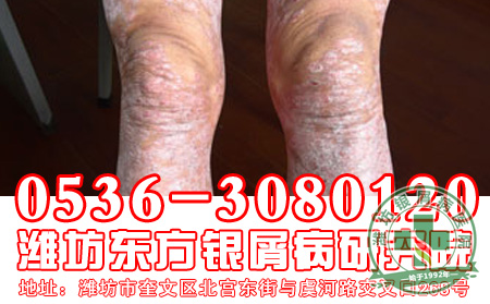 银屑病治疗常用的药物有哪些？