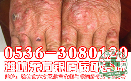 女性手部得了牛皮癣要注意什么呢
