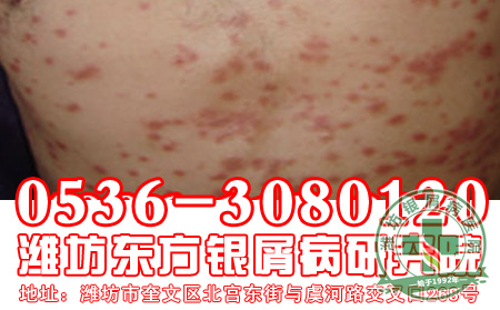 患者推荐：银屑病“食疗”小方法