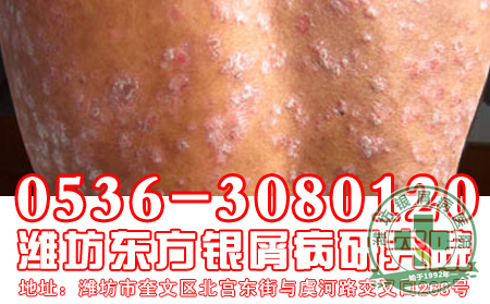 银屑病患者能吃黄瓜么？