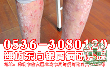 秋冬季节银屑病加重的原因有哪些