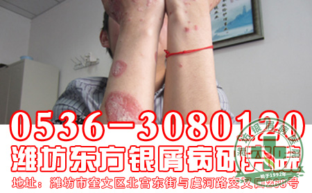 点滴型银屑病常见的症状有哪些?