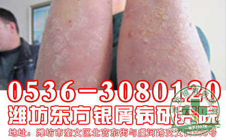 牛皮癣怎么彻底减轻呢?