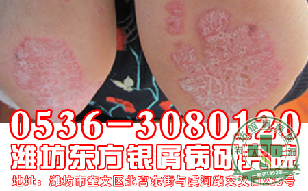 如何防止银屑病扩散呢