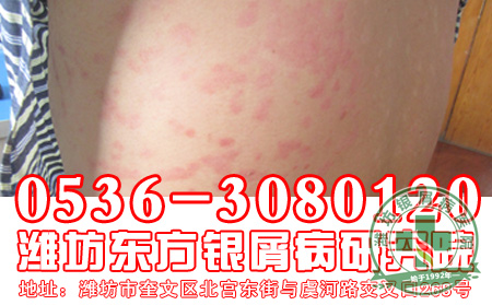  银屑病通常都是什么原因引起的？