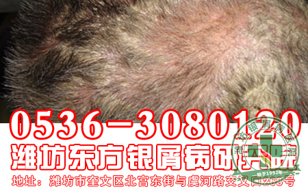 女性常见的银屑病病因有哪些？