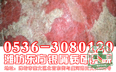 小儿银屑病有哪些症状表现?