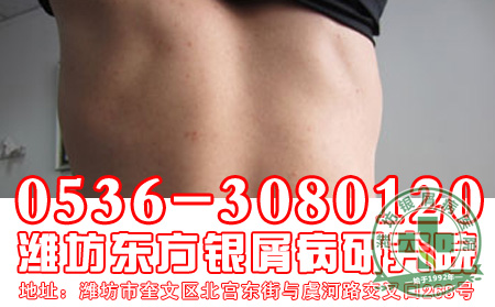 如何诊断头部银屑病？