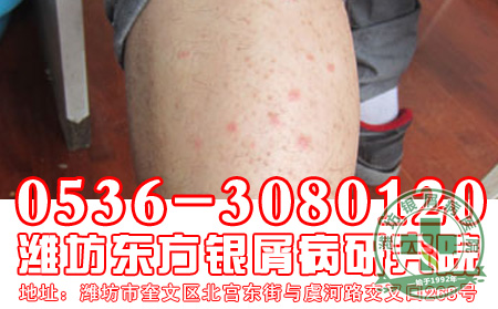 得了银屑病能用香皂洗浴吗?