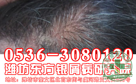头癣和银屑病有关系吗？