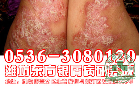 患者关注：什么原因会导致银屑病?