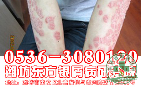 中年男性牛皮癣患者护理难不难?