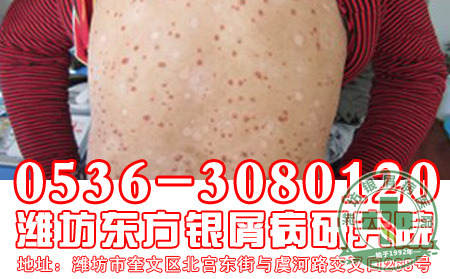 牛皮癣患者如何做好养生工作?