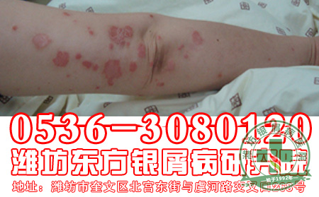那些年我们一起追过的银屑病女孩