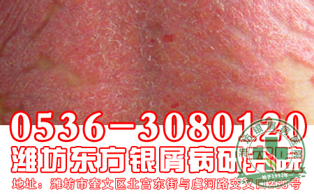 银屑病患者在平日里有什么禁忌吗