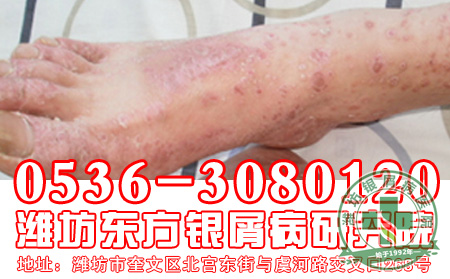 医患问答：银屑病怎么治疗 好