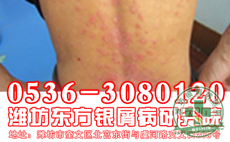 牛皮癣伸魔爪，体质偏弱的朋友要警惕