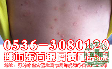 做“三好先生”，远离银屑病