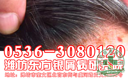 春天银屑病会不会复发？