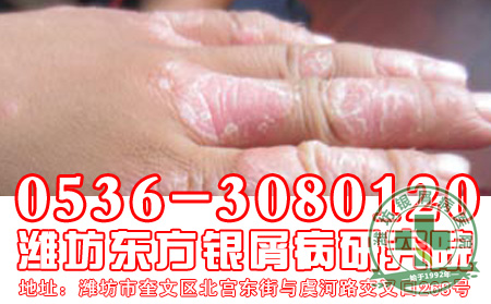 济南银屑病专科医院教你如何护理银屑病