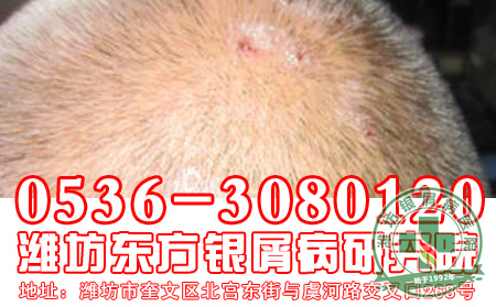 主任解析：中、西医疗法治疗银屑病哪个好？