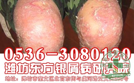患者推荐！银屑病治疗首选偏方