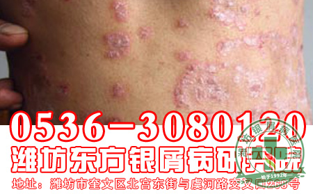 主任推荐！ 可靠的银屑病诊断方法介绍
