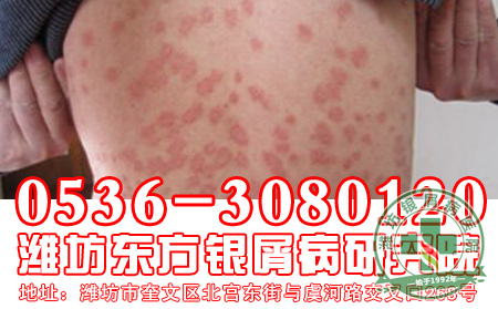 不得不说的银屑病治疗误区