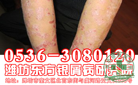 夏季银屑病患者要警惕雨水的危害