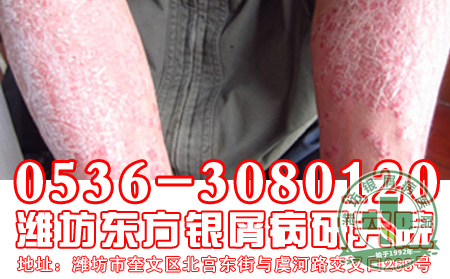 秋季脚部牛皮癣患者要注意什么?